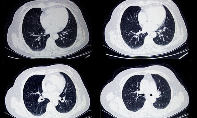 lung cancer