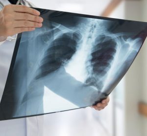 lung-cancer-biomarker-CKAP4