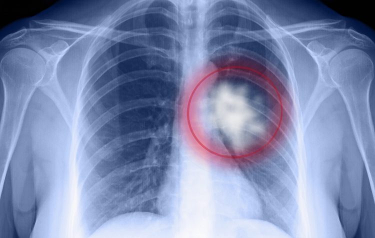 x-ray of chest with lung cancer circled in red