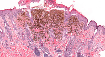 NGLY1 melanoma