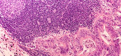 metastatic cancer