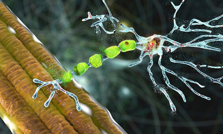 Degradation of motor neurons, conceptual 3D illustration. Motor neuron diseases are a group of neurodegenerative disorders including amyotrophic lateral sclerosis, progressive bulbar palsy and other