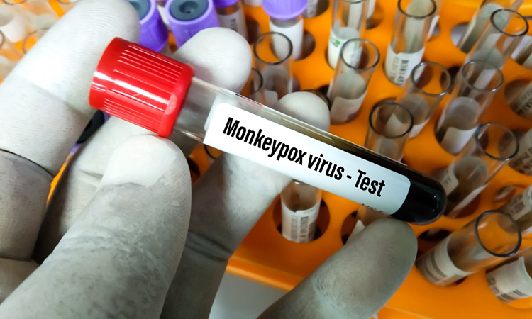 Blood sample tube for Monkeypox virus test