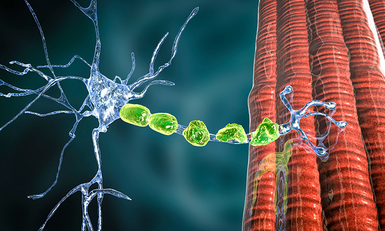 Demyelination of neuron, the damage of the neuron myelin sheath seen in demyelinating diseases, 3D illustration. Multiple sclerosis and other demyelinating myelinoclastic and leukodystrophic diseases