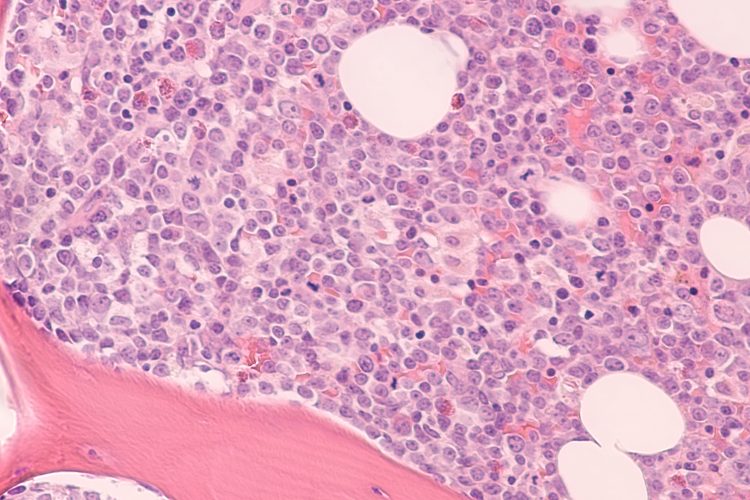 Photomicrograph of bone marrow biopsy showing myeloblasts of acute myeloid leukemia (AML), a cancer of white blood cells.