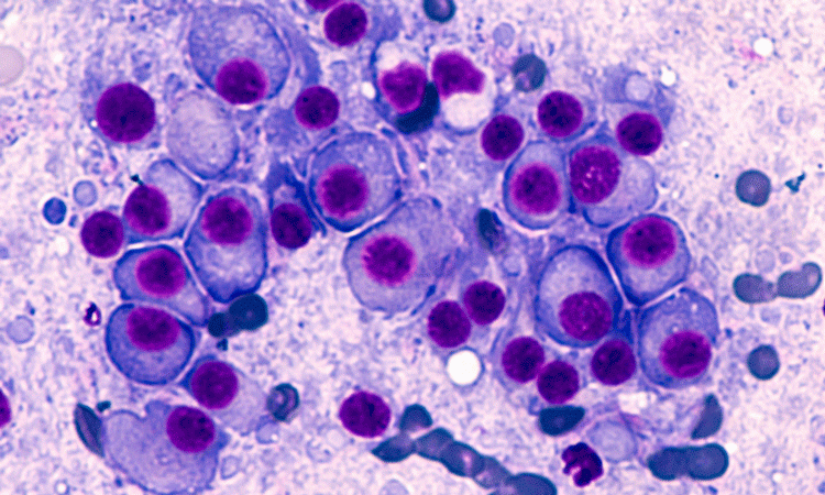 myeloma