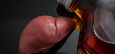 Alcoholic liver damage and cirrhosis concept with a liver next to a flask of alcohol. Cirrhosis is most commonly caused by alcoholism, hepatitis B or C or non-alcoholic fatty liver disease