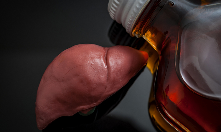 Alcoholic liver damage and cirrhosis concept with a liver next to a flask of alcohol. Cirrhosis is most commonly caused by alcoholism, hepatitis B or C or non-alcoholic fatty liver disease