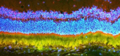 In experiments in rats and mice, two Johns Hopkins scientists -- an engineer and an ophthalmologist -- report the successful use of nanoparticles to deliver gene therapy for blinding eye disease. A uniquely engineered large molecule allows researchers to compact large bundles of therapeutic DNA to be delivered into the cells of the eye [credit: John Hopkins Medicine].