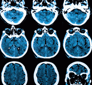 alexander disease