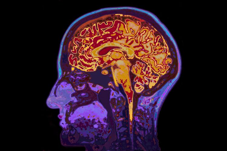 sagittal (side through view) magnetic resonance image of the brain with skull and supporting structures in purple and brain and brainstem in red and orange