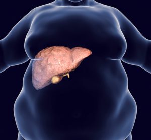 Obese man with fatty liver, 3D illustration. Conceptual image for non-alcoholic fatty liver disease