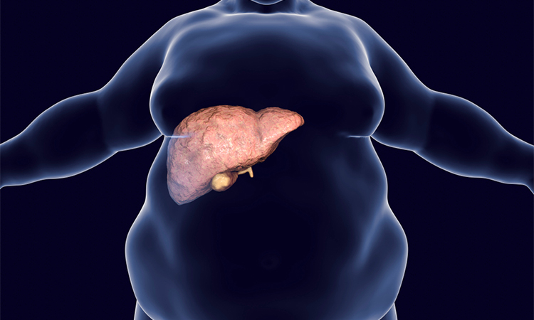 Obese man with fatty liver, 3D illustration. Conceptual image for non-alcoholic fatty liver disease