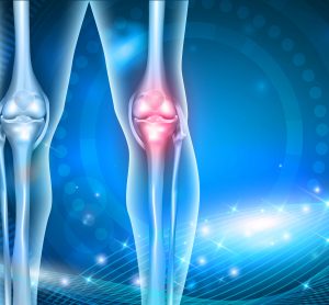 osteoarthritis
