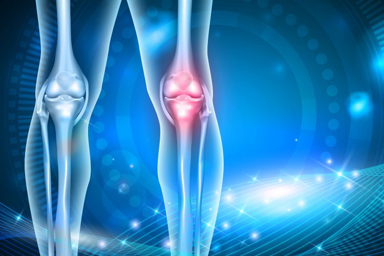 osteoarthritis