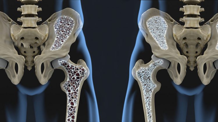 cartoon of two hips and femurs - left on with large black dots in the bone indicating osteoporosis (bone being removed and becoming spongy), the other with smaller dots indicating normal bone