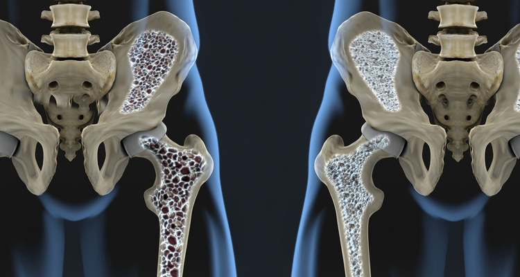 New target for treating conditions that weakens bones, such as osteoporosis.