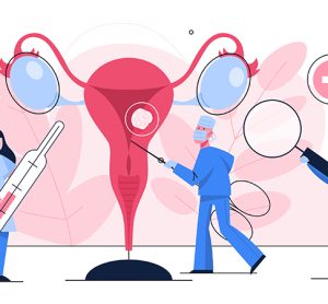 ovarian cancer