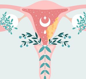 ovarian cancer