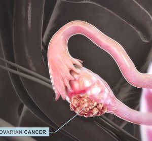 3D illustration of ovarian cancer