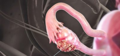 3D illustration of ovarian cancer