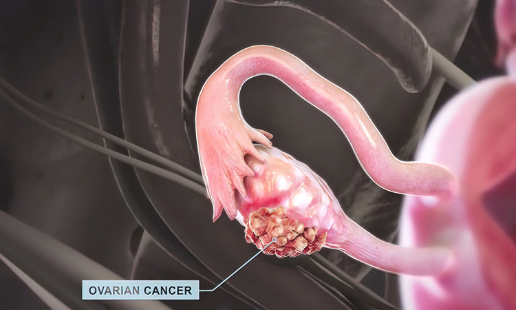 3D illustration of ovarian cancer