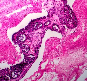 Ovarian cancer