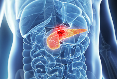 pancreatic cancer