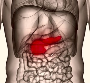 pancreatic cancer