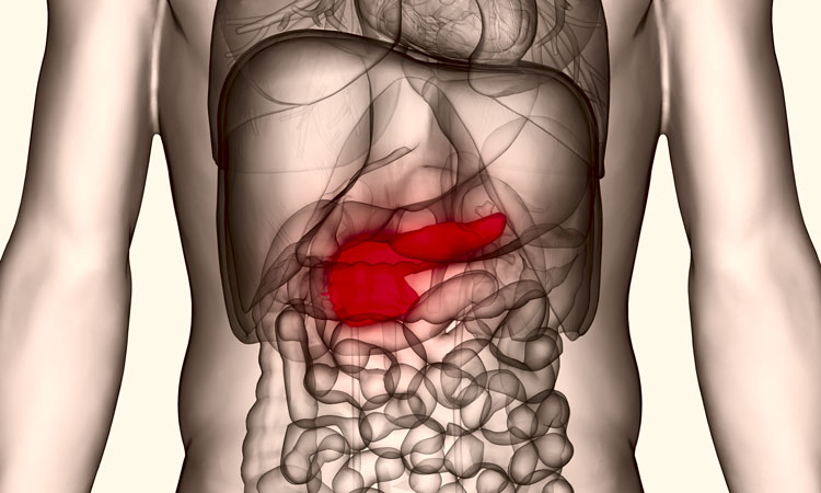 pancreatic cancer