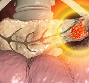 3D rendering of a pancreas in cream with a glowing red mass - indicating pancreatic cancer