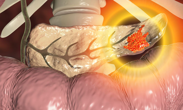 3D rendering of a pancreas in cream with a glowing red mass - indicating pancreatic cancer