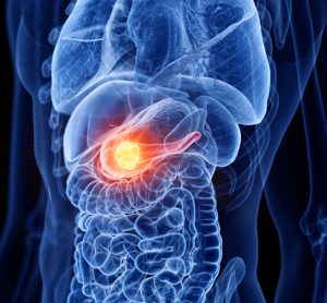 Image showing pancreatic cancer