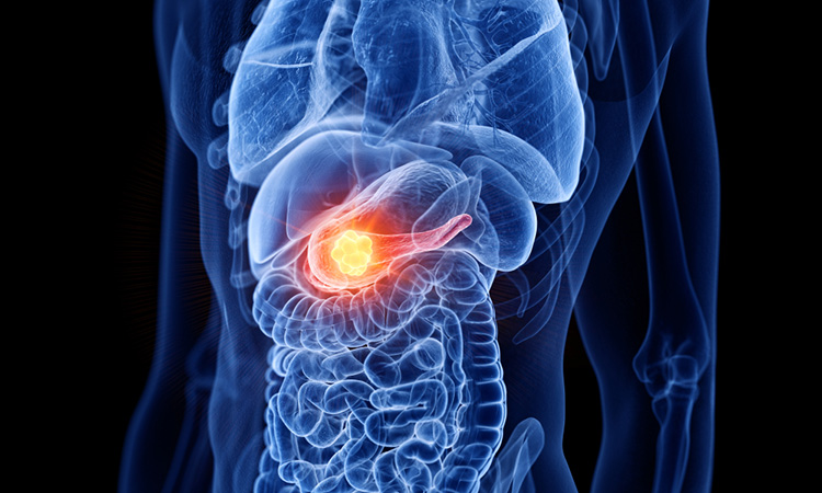 Image showing pancreatic cancer