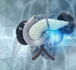 pancreatic cancer