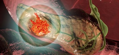pancreatic cancer