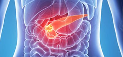 pancreatic cancer