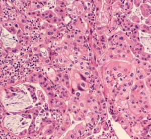 Pancreatic cancer cells