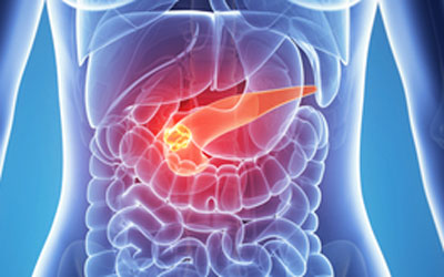 pancreatic cancer