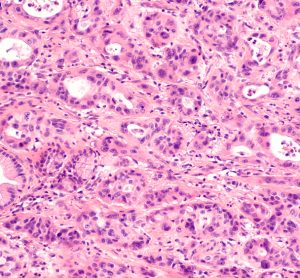 Pancreatic cancer