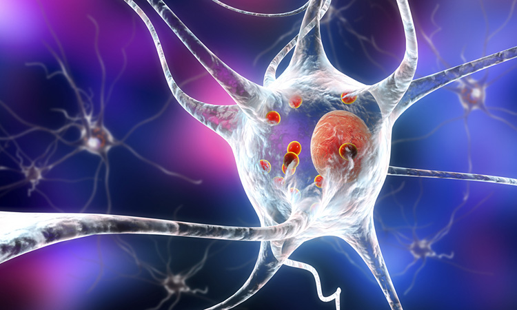 3D illustration showing neurons containing Lewy bodies small red spheres which are deposits of proteins accumulated in brain cells that cause their progressive degeneration