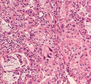 pancreatic