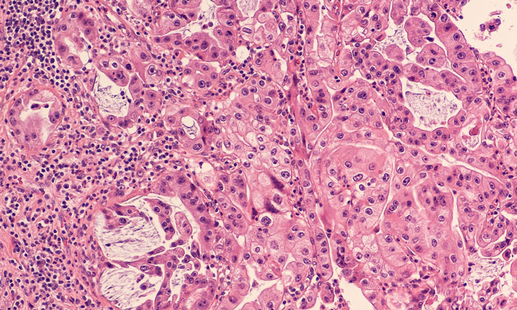 pancreatic