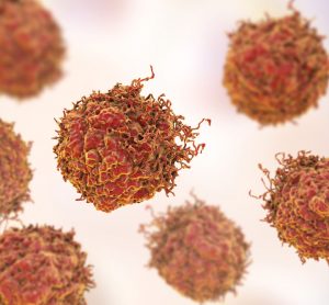 prostate cancer