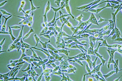 prostate cancer