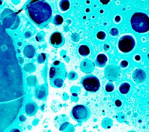 prostate tumour cancer