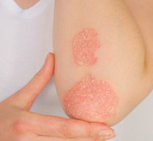 Elbow with psoriasis