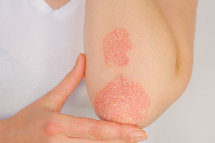 Elbow with psoriasis