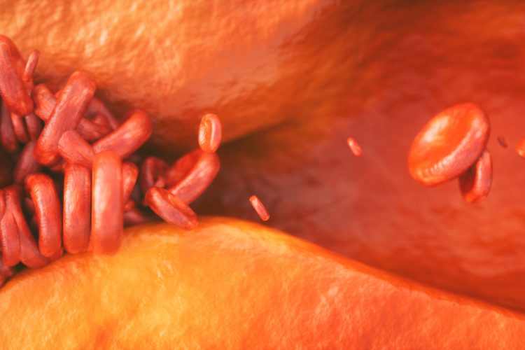 red blood cells being restricted in a blood vessel by its bulging walls caused by atherosclerosis