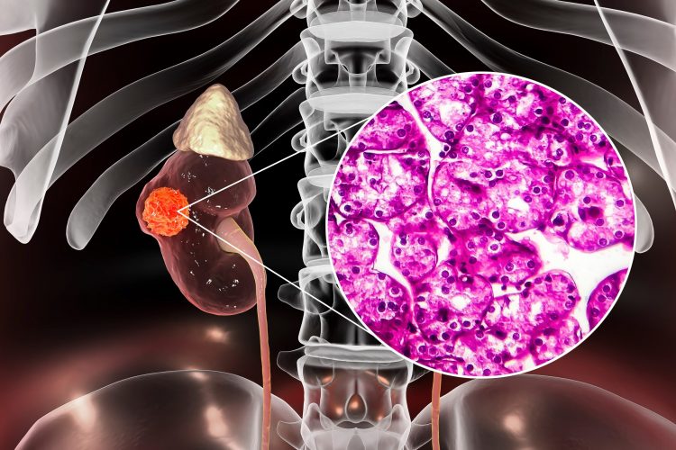 kidney in a human torso with a cutaway showing a microscopy image of renal cell carcinoma